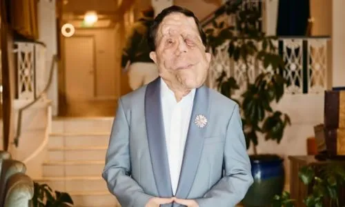 Adam Pearson, 1er acteur handicapé à incarner Elephant man