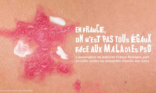Illustration article Psoriasis : trop de disparité d'accès aux soins en France