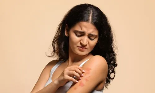 une jeune femme atteinte d&rsquo;ecz&eacute;ma se gratte