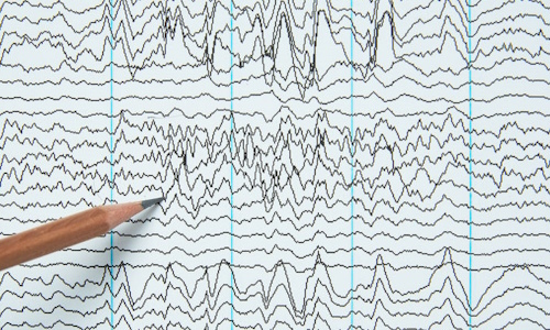 Mieux comprendre l'épilepsie