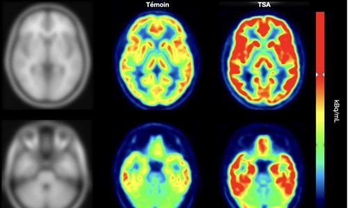 Illustration article Etude : un récepteur du cerveau mis en cause dans l'autisme