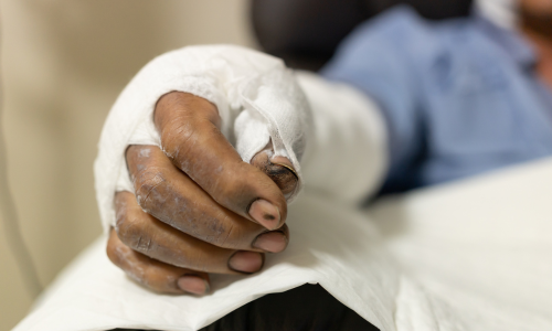 patient &agrave; l'h&ocirc;pital avec une br&ucirc;lure
