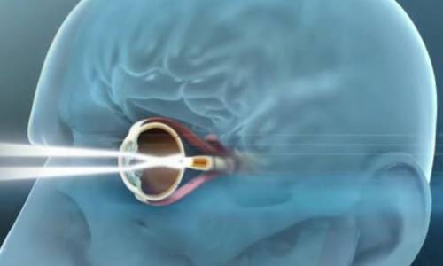 Illustration article Cécité, un implant rétinien "dernier cri" posé avec succès