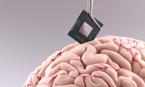 Un implant cérébral intégré dans un cerveau humain.