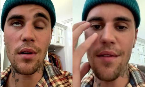 J.Bieber : Ramsay Hunt, le syndrome qui paralyse son visage 