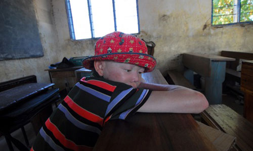Illustration article Malawi : un prêtre condamné pour le meurtre d'un albinos