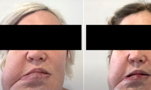 évolution du visage d’une femme atteinte de myohyperplasie hémifaciale