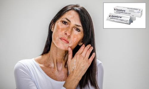 Le visage d’une femme atteinte de vitiligo et, à côté, la crème Opzelura.