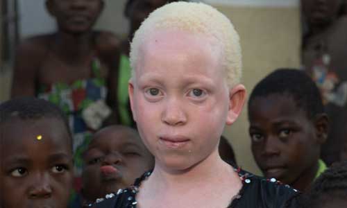 Illustration article Sauver Annie, 10 ans, albinos, menacée de mort 