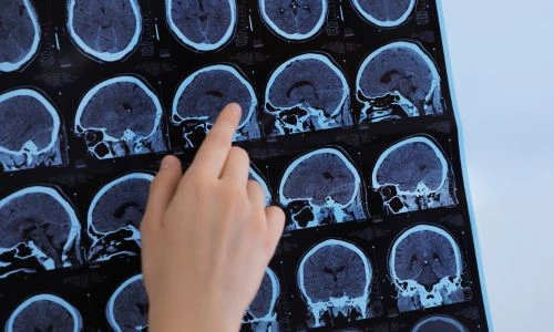 Un m&eacute;decin examine les images IRM d'un patient atteint de scl&eacute;rose en plaques