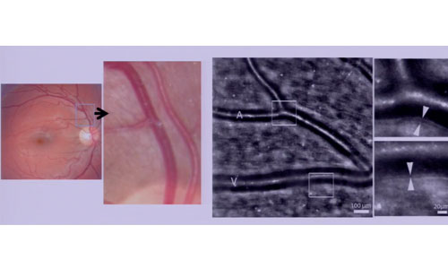 Illustration article Vision : un chercheur combat l'occlusion veineuse rétinienne