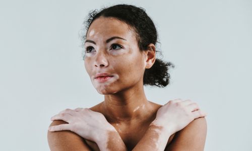 : Jeune femme brune avec un vitiligo (peau mate couverte de taches blanches)