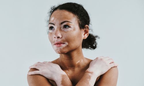 Vitiligo : et si les acariens étaient en cause ? 