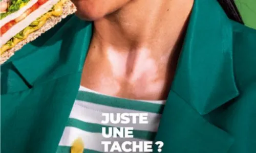 Affiche de campagne / personne atteinte de vitiligo qui mange un sandwich